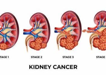Stakeholders Sound Alarm on Kidney Cancer, Advocate Early Detection