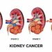 Stakeholders Sound Alarm on Kidney Cancer, Advocate Early Detection